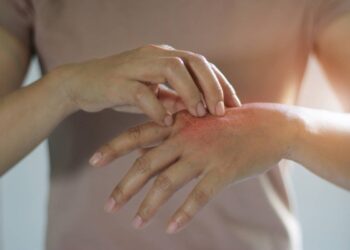 Calcaire et eczéma : un mélange à éviter à tout prix !