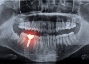 La 3D au secours de la chirurgie dentaire