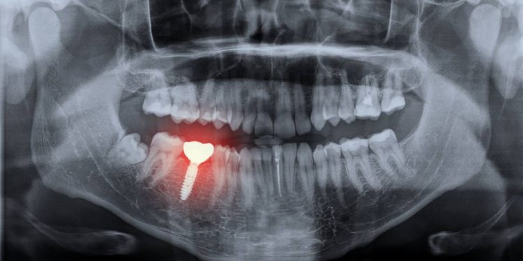 La 3D au secours de la chirurgie dentaire